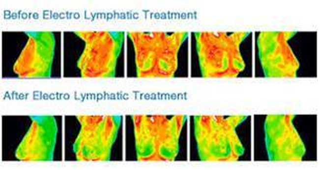 Before and After Electro Lymphatic Treatment