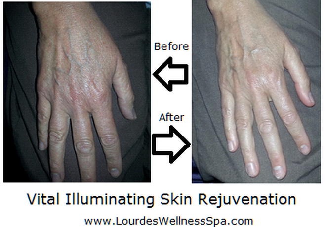 Vital Illuminating Skin Rejuvenation Before and After